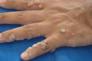 warts | WomensByte