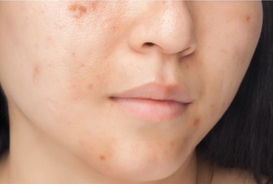 acne acne