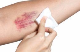 heal bruises heal bruises