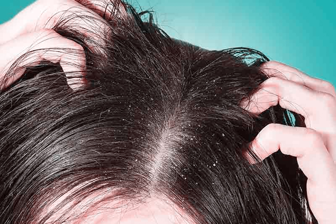 Get Rid Of Dandruff