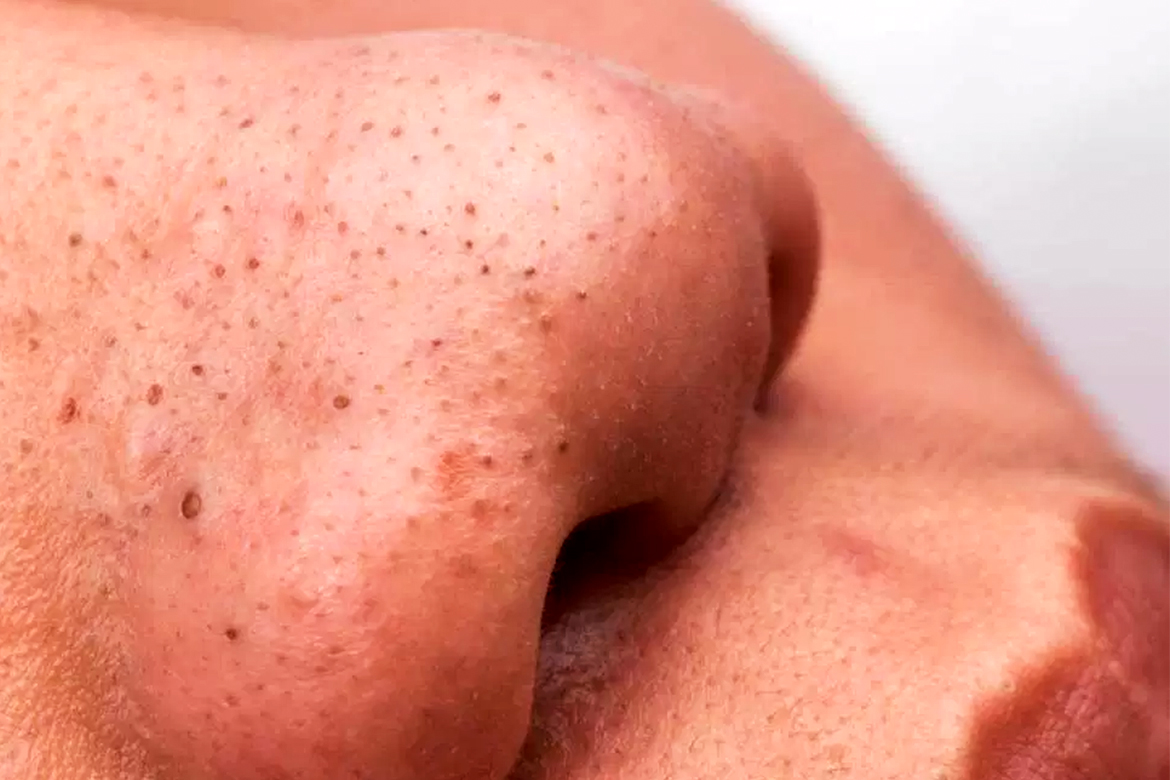 Blackheads