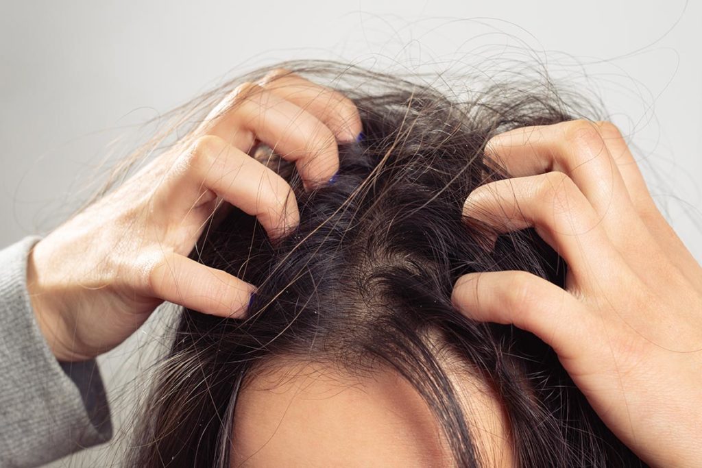 Lower Your Scalp Itching Level
