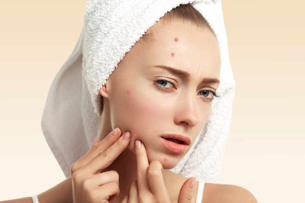 Pimples in Oily-Skin