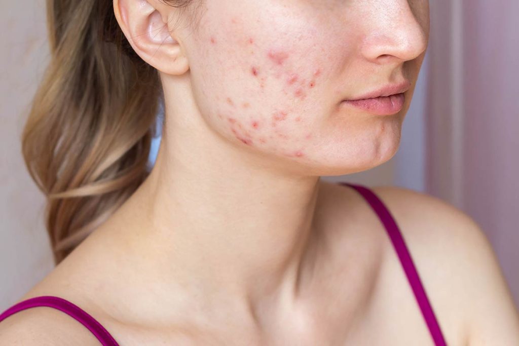 cystic acne